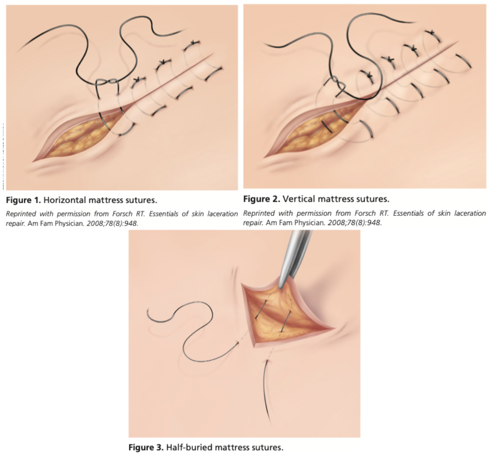 Vertical and Horizontal Mattress Sutures