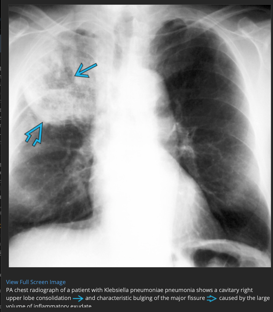 PA View of Klebsiella Pneumonia