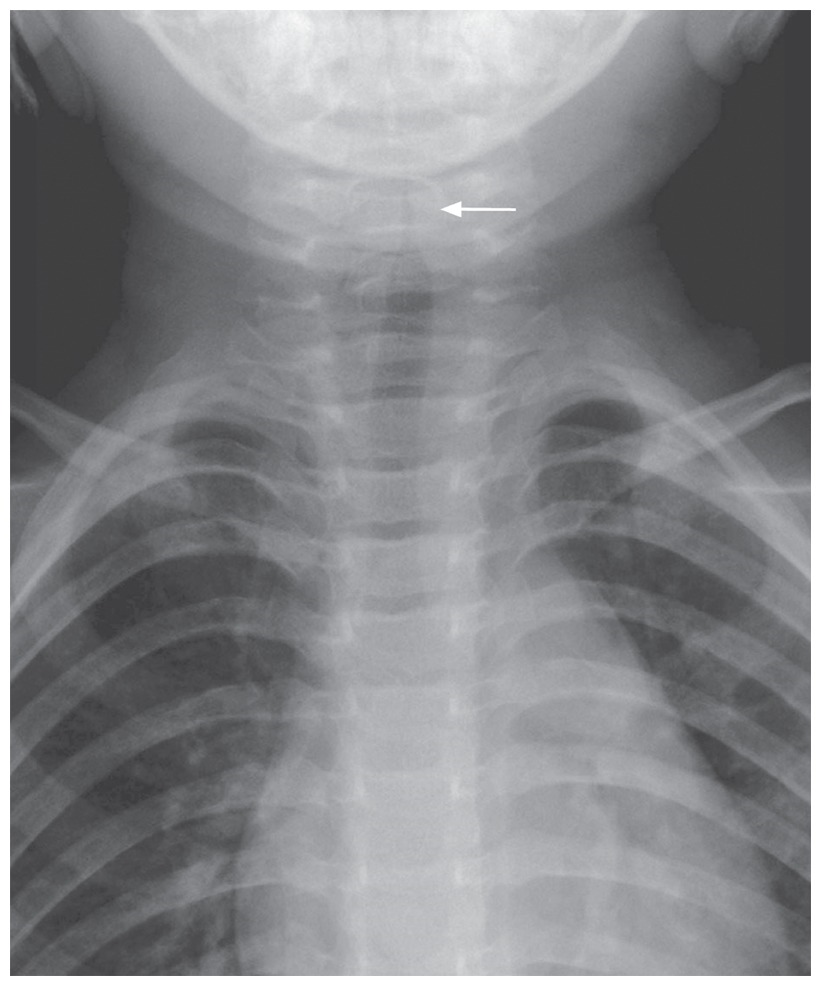 Steeple sign chest x ray