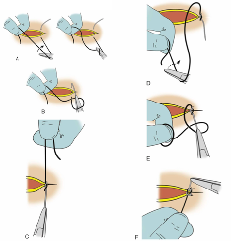 Photo Description of how to tie a suture