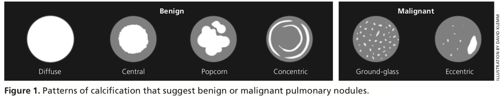 Pulmonary Nodule Calcification