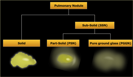 pulmonary nodule